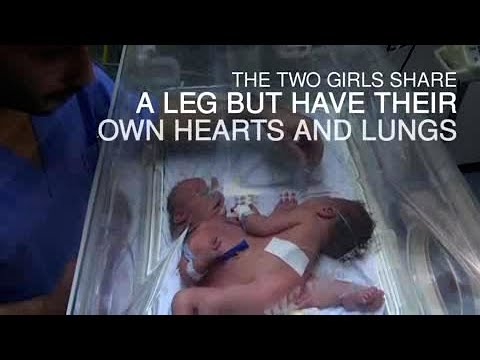 Kembar Siam Langka Lahir di Gaza Butuh Segera Perawatan di Luar Negeri