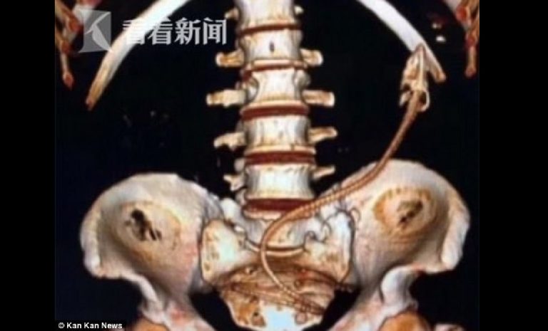 Foto CT Scan Mengejutkan Pria Sebaya Memiliki Belut yang Terjebak di Dalam Tubuhnya