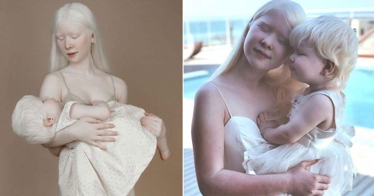 Dua Beraudara Albino yang Berselisih 12 Tahun Ini Sangat Mengesankan Semua Orang