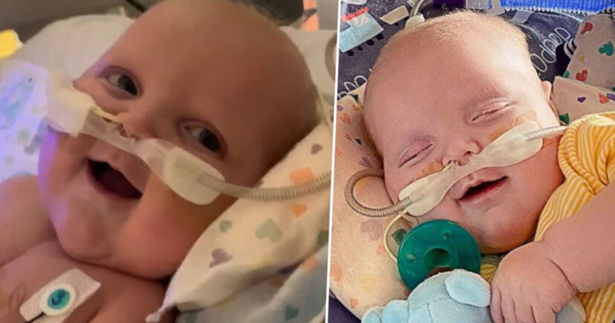  Bayi  yang Menjalani Dua Operasi Jantung  Terbuka Senyum 