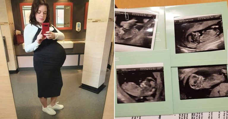 Dokter Harus Menelan Kata-katanya Setelah Menghadiri Kelahiran Bersejarah yang Terjadi 1 dalam 200 Juta Kelahiran