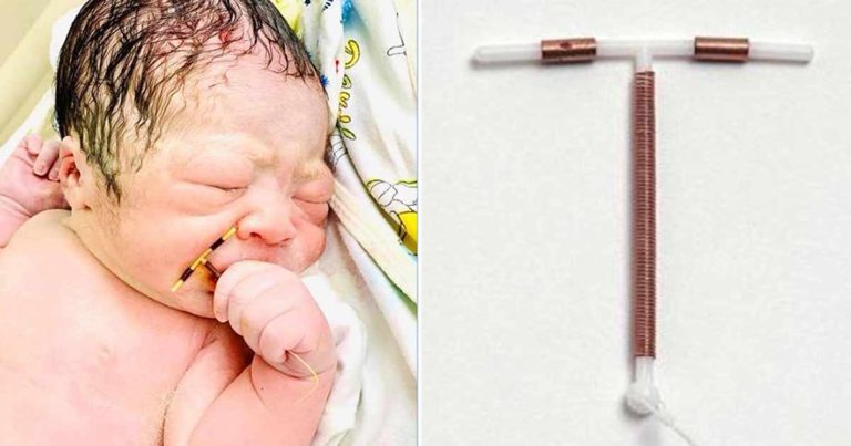 Bayi Lahir Memegang Alat Kontrasepsi Ibunya yang Gagal
