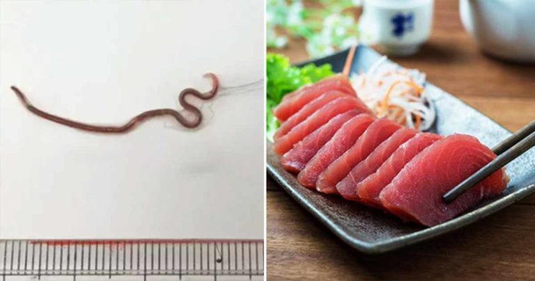Dokter Menemukan Cacing Sepanjang 3,8 Sentimeter di Mulut Seorang Wanita Setelah Dia Makan Sashimi