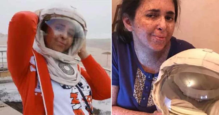 Wanita dengan Kondisi Genetik Langka, Dia Alergi Terhadap Sinar UV dan Harus Memakai ‘Helm Ruang Angkasa’