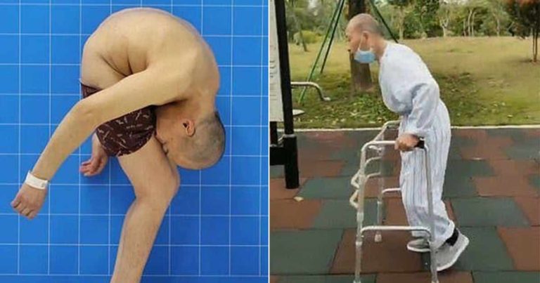 Setelah Lebih dari 20 Tahun dengan Wajah Menempel di Pahanya, Kini Dia Berjalan Tegak untuk Pertama Kalinya