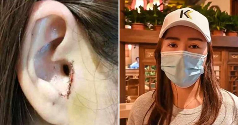 Wanita Tanpa Sadar Bagian Telinganya Diangkat Selama Operasi Hidung