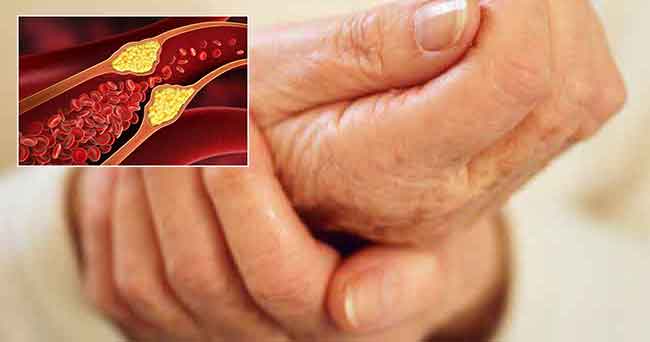 Tanda-tanda Kolesterol Tinggi pada Jari Kaki dan Jari Tangan yang Menunjukkan Tingkat Berbahaya