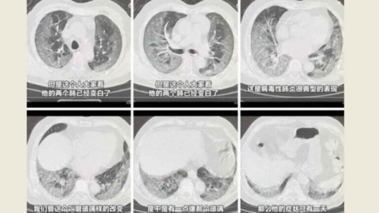 Paru-paru Putih Kembali Menyerang, Beijing Duduki Kasus COVID-19 Tertinggi Selama 5 Minggu Berturut-turut Hingga Zhongnanhai Tiarap 