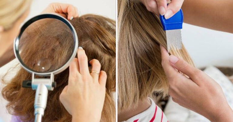 Ibu Menolak Membunuh Kutu Rambut Putrinya Karena Dia ‘Vegan’