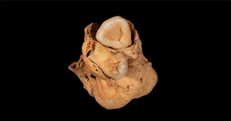 Tumor ‘Bergigi’ Berusia 3000 Tahun Ditemukan di Situs Pemakaman Kuno