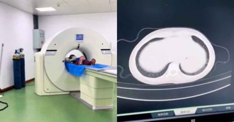 Bocah Laki-laki  Berusia 7 Tahun Penderita “Paru-Paru Putih” di Anhui, Tiongkok  Menjalani “Cuci Paru-Paru”