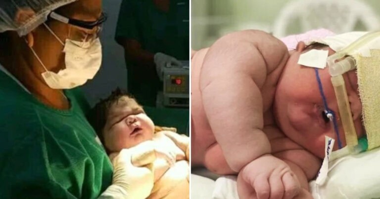 Wanita Membuat Dokter Tertegun Setelah Melahirkan Bayi Raksasa Setinggi 60 Sentimeter Melalui Operasi Caesar
