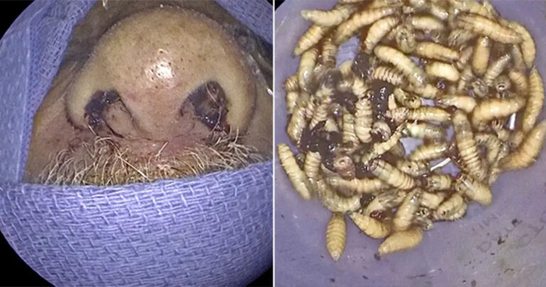 Dokter Mengeluarkan 150 Serangga Hidup dari Hidung Seorang Pria, Dia Tidak Tahu Ada Serangga di Hidungnya