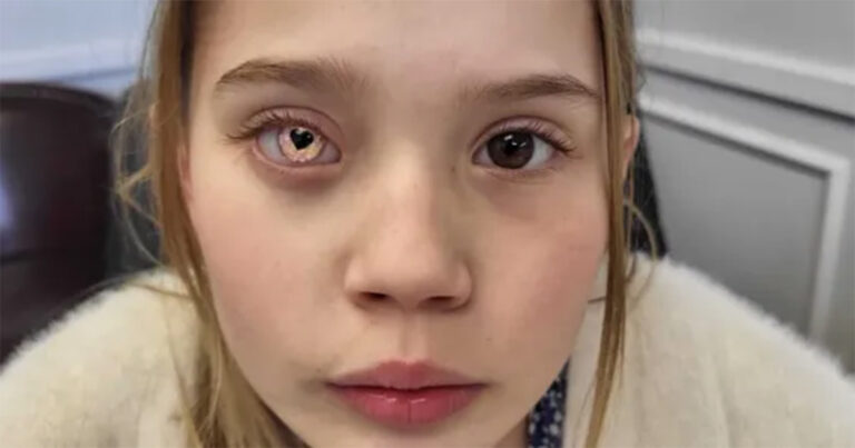 Gadis Mendapat Mata Bionik Setelah Menderita Kondisi yang Sangat Langka
