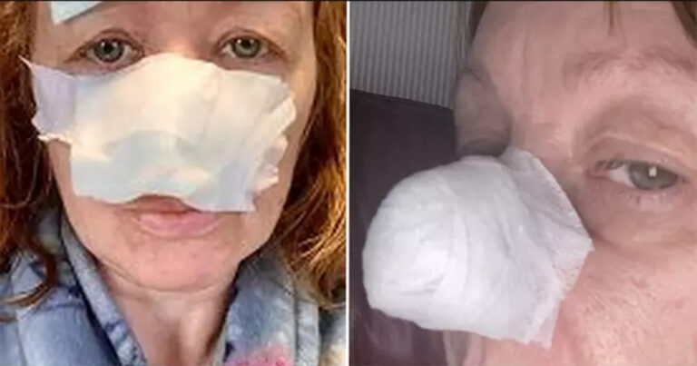 Wanita Kehilangan Sebagian Hidungnya Setelah Bercak yang Diabaikan oleh Dokter Ternyata Adalah Kanker