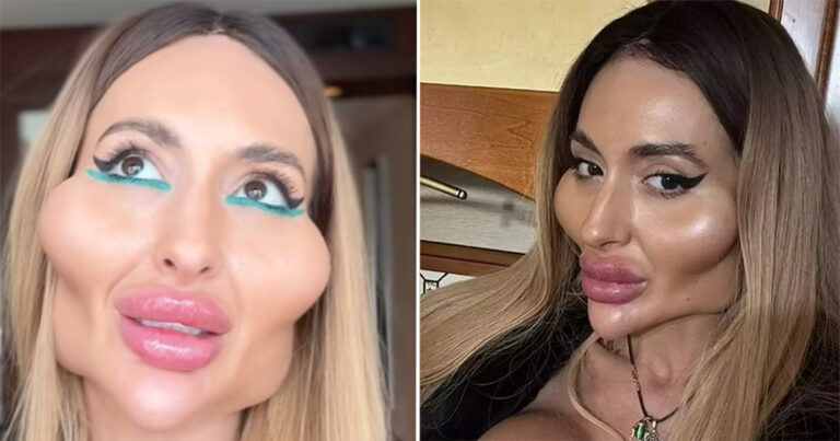 Influencer dengan ‘Pipi Terbesar di Dunia’ Berbagi Gambar Tentang Penampilannya Sebelum Filler Senilai Lebih dari Rp 30 Juta