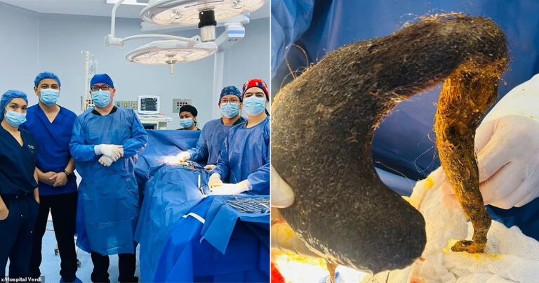 Dokter Mengeluarkan Gumpalan Rambut Seberat Hampir 1 Kg dari Perut Wanita Berusia 24 Tahun