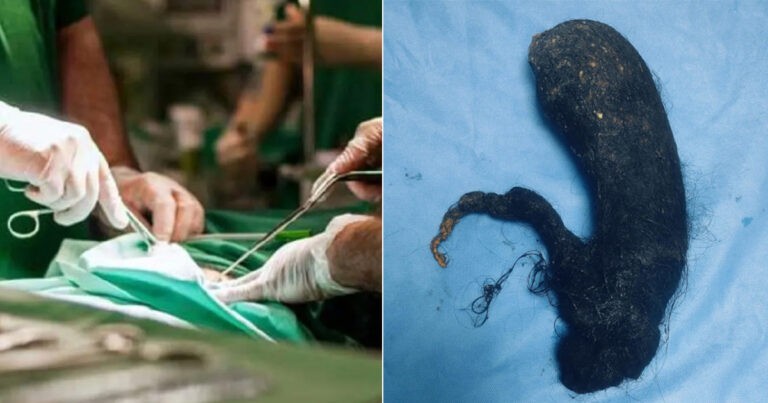 Dokter Bedah di India Mengeluarkan 1,5 Kg Rambut dari Perut Seorang Gadis Muda