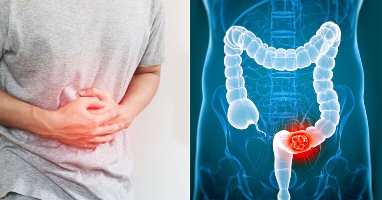 Dokter Ungkap 6 Tanda Umum Kanker Usus Besar yang Perlu Diwaspadai pada Anak Muda