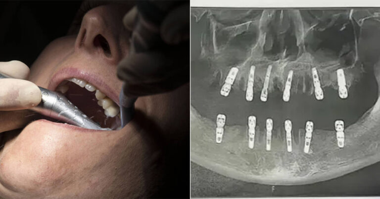 Seorang Pria di Tiongkok Meninggal Karena Serangan Jantung Setelah Mencabut 23 Gigi dan Memasang 12 Gigi dalam Sehari