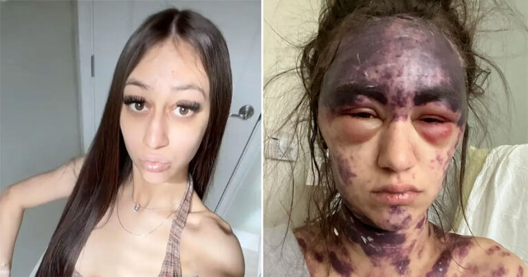 Wanita Menjadi Buta dan Tubuhnya Membiru Setelah Menerima 3 Vaksin Sekaligus