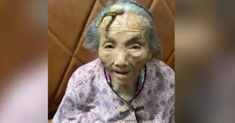 Nenek Berusia 107 Tahun di Guangdong, Tiongkok  Ini Ditumbuhi ‘Tanduk Umur Panjang’ yang langka di dahinya