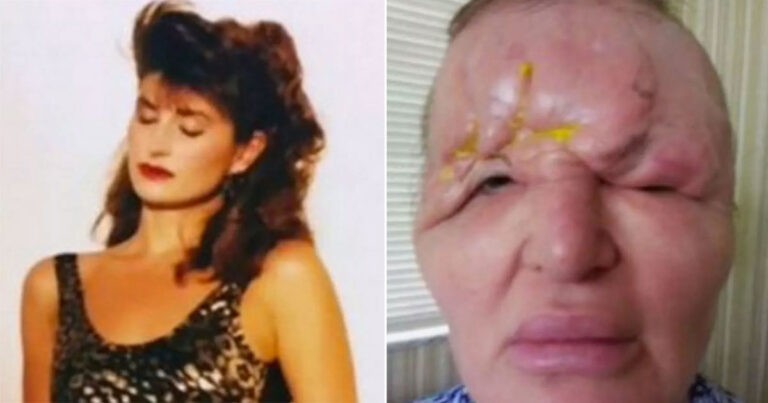 Model Terlihat Seperti ‘Monster’ Setelah Prosedur Kosmetik yang Gagal