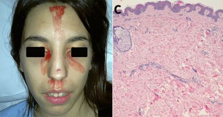 Wanita yang Mengeluarkan Darah dari Wajah dan Telapak Tangannya Didiagnosis dengan Kondisi Medis Langka