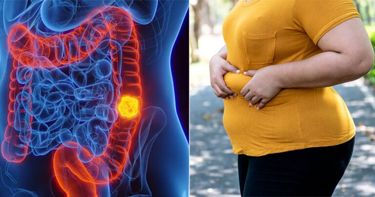 Studi Baru Mengungkap Faktor Risiko Terbesar Kanker Usus Besar pada Orang di Bawah Usia 35 Tahun, Ini Akan Mengejutkan Anda