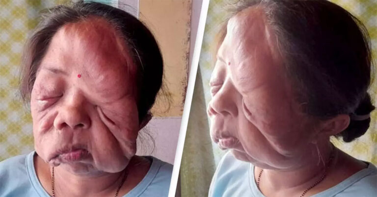 Wanita yang Wajahnya ‘Meleleh’ dari Kepalanya Berbicara Tentang Bagaimana Hidup dengan Kondisi Tersebut