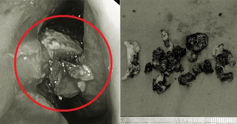 Dokter Bengeluarkan ‘Bola Jamur’ Besar dari Hidung Wanita di Taiwan Setelah Mengeluarkan ‘Bau Kaki’