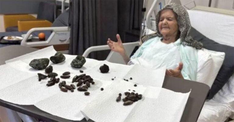 Dokter di Turki Mengeluarkan 63 Batu dari Perut Wanita Berusia 92 Tahun, Termasuk 5 Batu Seukuran Kepalan Tangan