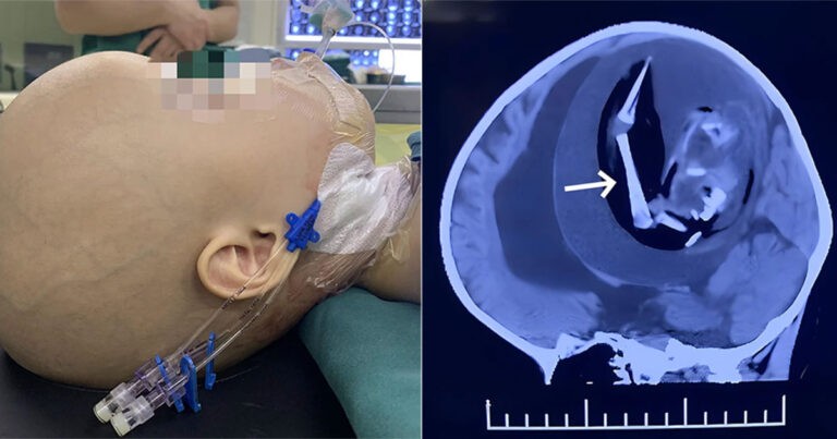 Gadis Berusia 1 Tahun di Tiongkok Menjalani Operasi Setelah Dokter Menemukan Janin di Otaknya