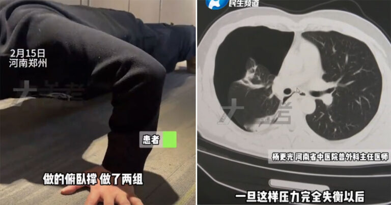 Pria di Tiongkok Melakukan Push-Up dan Lompat Tali untuk Menurunkan Berat Badan Sebagai Resolusi Tahun Baru, Paru-parunya Kolaps
