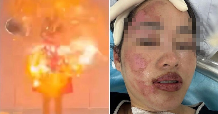 Wajah Wanita Terbakar Setelah Balon di Pesta Ulang Tahunnya Terbakar dan Meledak