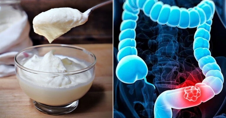 Studi Baru : Yogurt Menunjukkan Potensi Besar Melawan Kanker Usus Besar