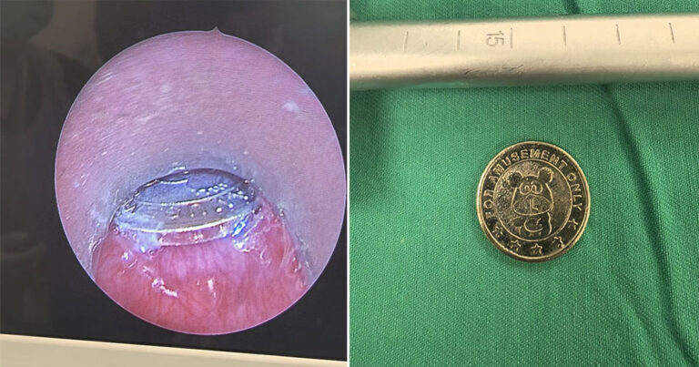 Anak di Malaysia Menjalani Operasi Darurat Setelah Menelan Token Arcade, Dokter Menghimbau Agar Orangtua Waspada