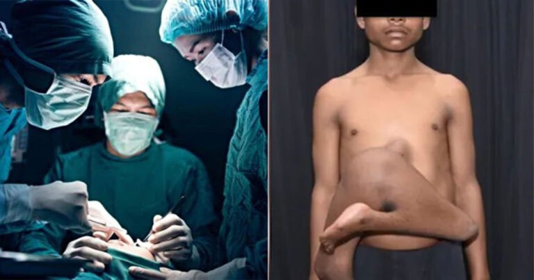 Dokter di India Lakukan Operasi pada Anak Laki-laki dengan 2 Kaki Tambahan yang Menempel di Perutnya