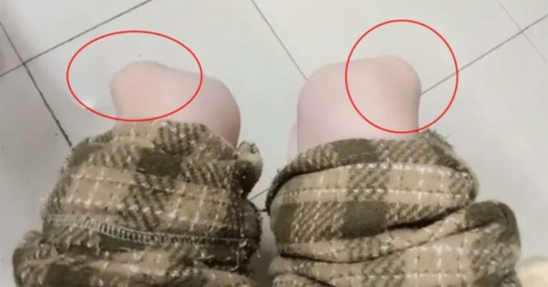 Gadis yang Lahir dengan ‘Dislokasi Patela’ Dapat Menggeser-geser Tempurung Lututnya Sesuka Hati