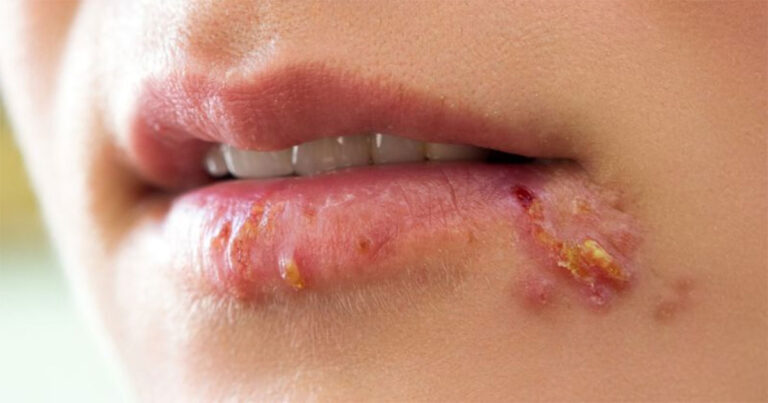 Menurut Studi : Herpes Lebih Mudah Menyerang Otak Kita Daripada Dugaan Kita