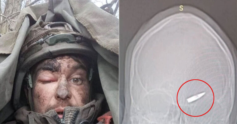 Tentara Rusia Diduga Bertempur Selama Seminggu dengan Peluru Tertancap di Otaknya