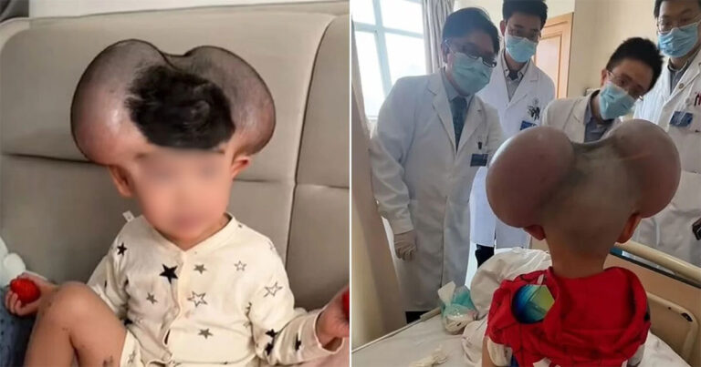 Bocah di Tiongkok Dijuluki ‘Mickey Mouse’ Karena Kondisi Kulitya, Sembuh Setelah Operasi Berhasil