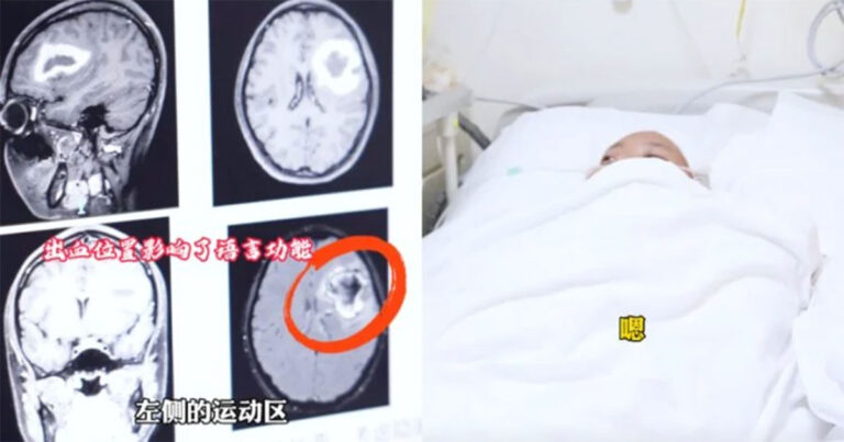Wanita Berusia 24 Tahun Secara Misterius Berhenti Berbicara dalam Bahasa yang Dulu Dia Sangat Fasih