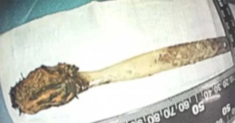 Dokter di Tiongkok Mengeluarkan Sikat Gigi dari Perut Seorang Pria Berusia 64 Tabub, Setelah Menelannya 50 Tahun Lalu