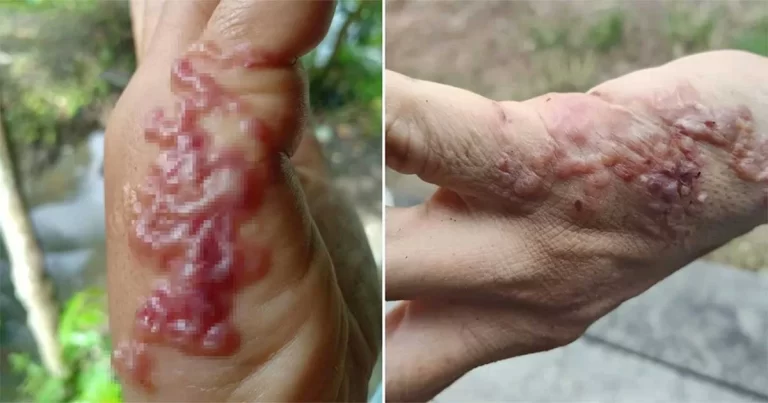 Wanita di Thailand Tertular Cacing Tambang Lewat Kulit, Kata Dokter Itu Akibat Kotoran Hewan