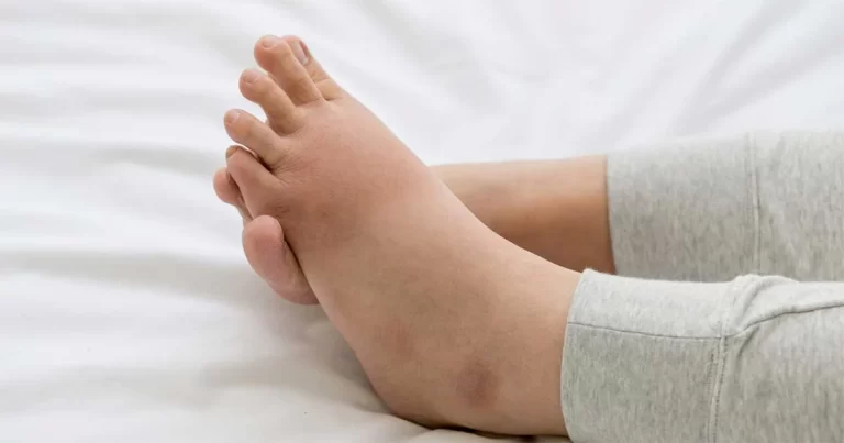 Waspadai Gejala Edema : Bisa Jadi Tanda Penyakit Serius