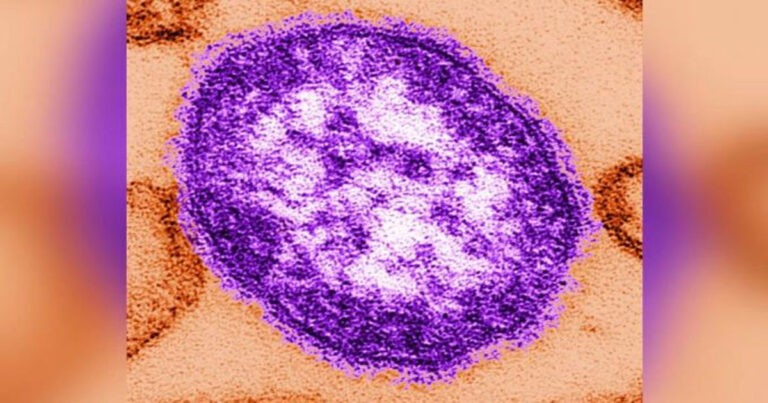 Wabah Campak Global Merebak, CDC AS Keluarkan Peringatan Perjalanan Tingkat 1
