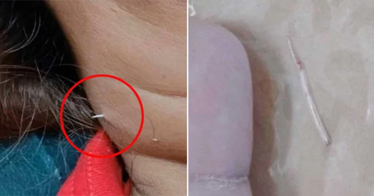 Tulang Ikan yang Tersangkut di Tenggorokan Seorang Wanita Akhirnya Keluar Sendiri dari Lehernya
