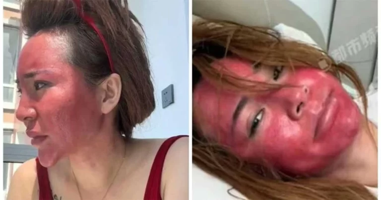 Wanita di Tiongkok dengan Ruam Wajah Parah Mengaku Tidak Menghapus Riasan Wajah Selama 22 Tahun