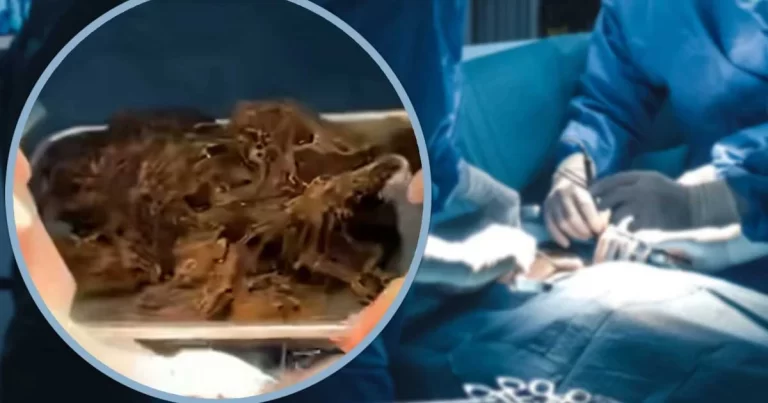Dokter di Tiongkok Mengeluarkan Gumpalan Rambut Seberat 2 Kg dari Perut Seorang Gadis